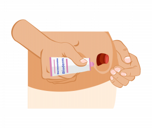 Applicazione di una piccola quantità di crema isodermico sulla cute attorno allo stoma per evitare irritazioni