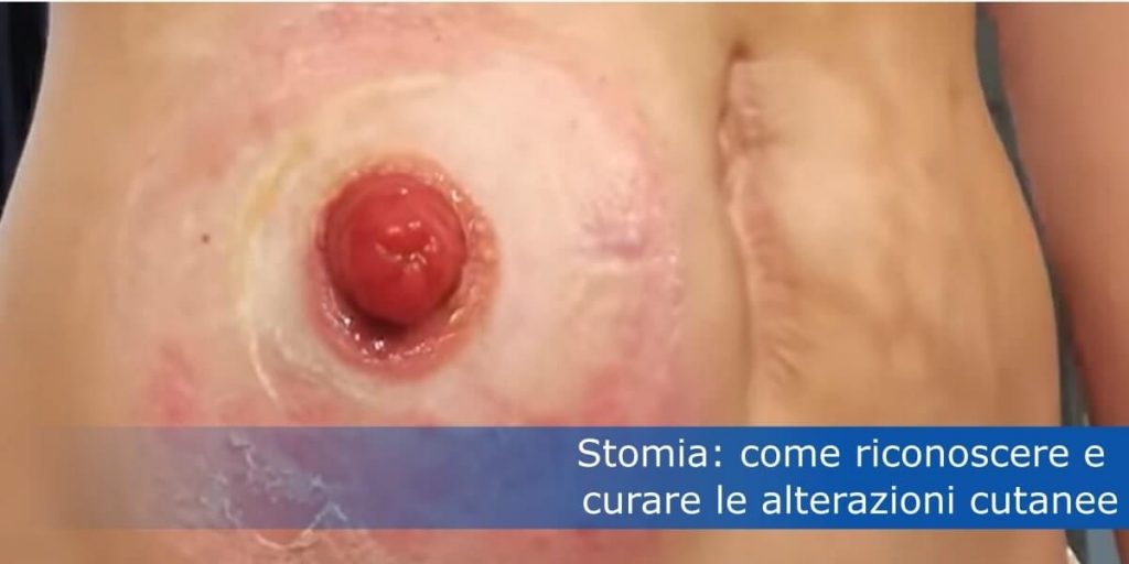 Ostomy: how to recognize and treat skin changes title picture
