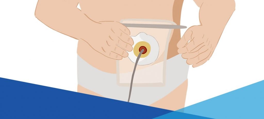 Krok 4: Zdejmij stożek i pozwól mu się opróżnić