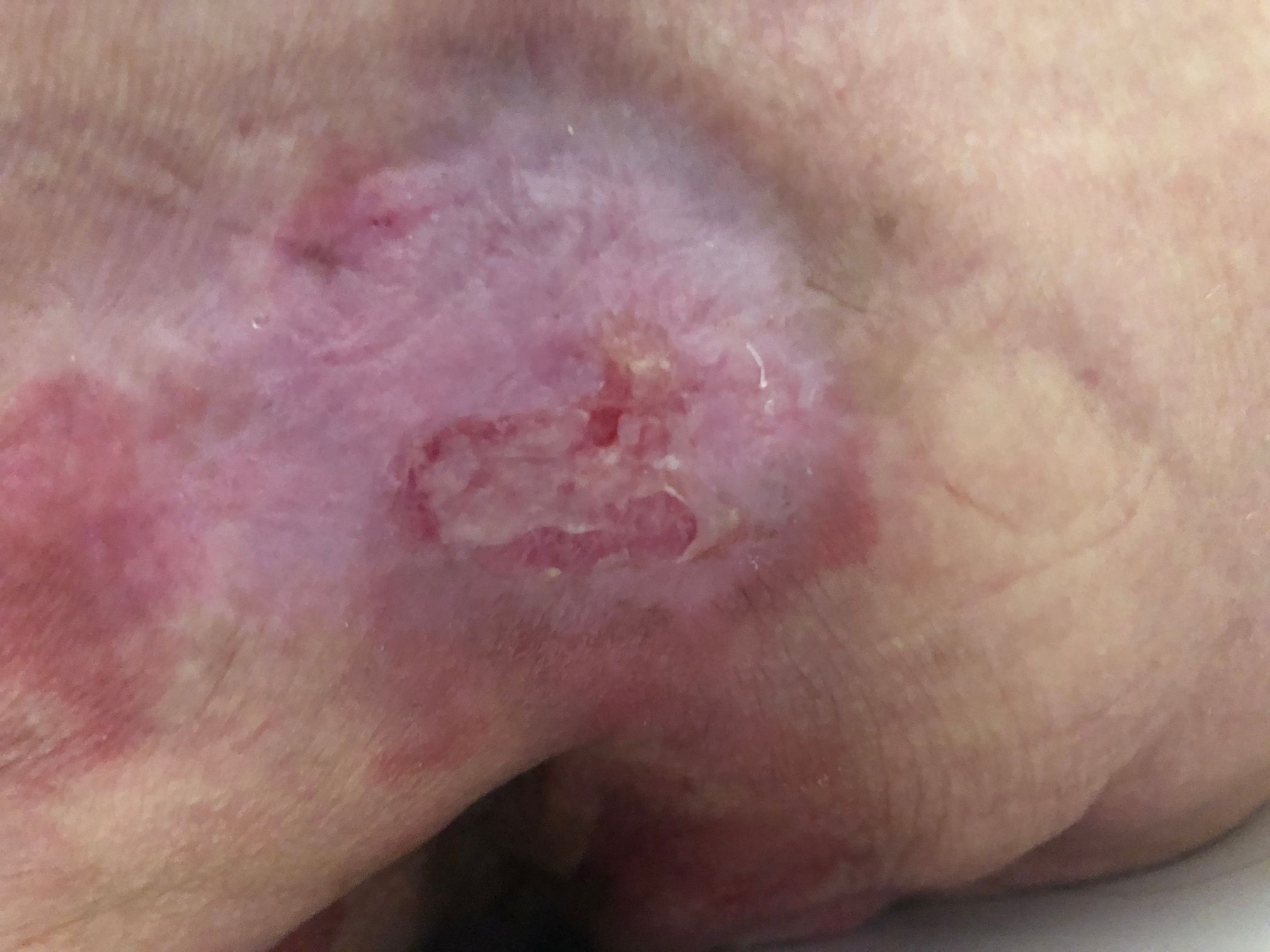 Piaghe da decubito in una persona anziana