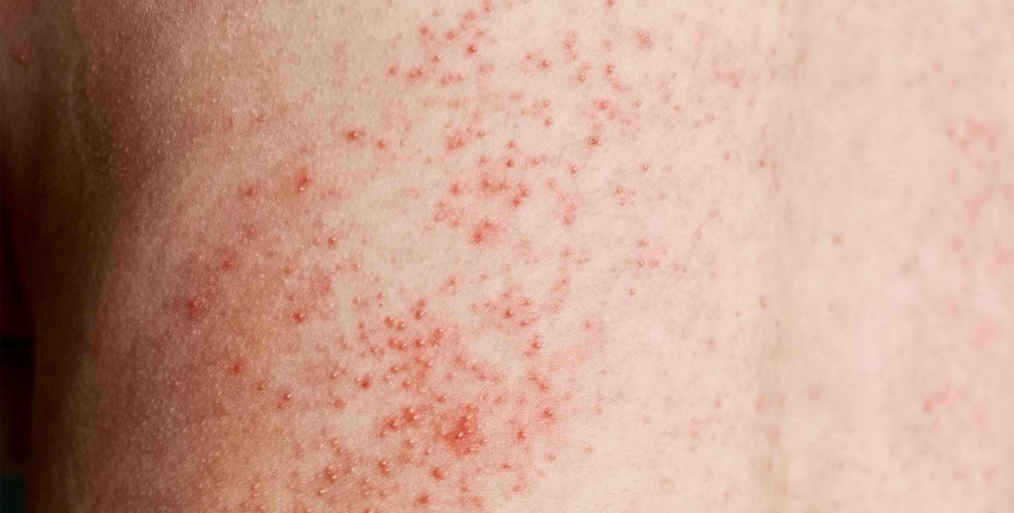 Pelle con eruzioni cutaneee che causano prurito