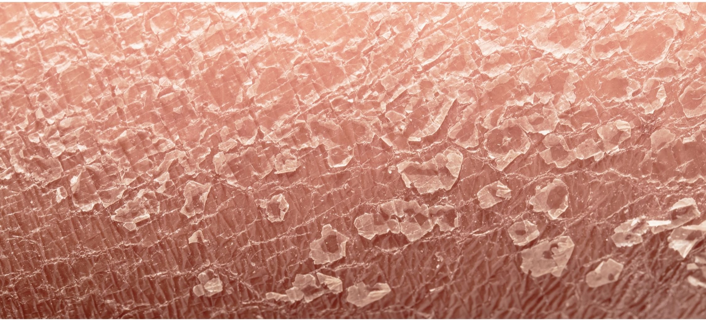 Pelle secca con xerosi